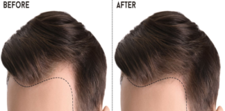 Hair Transplant for Men Turkey