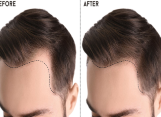 Hair Transplant for Men Turkey