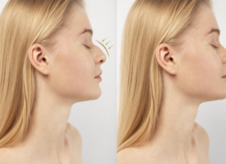 Rhinoplasty (Nose Job) in turkey